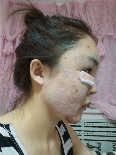 黑龙江瑞丽杨永胜自体脂肪全脸填充怎么样?案例分享