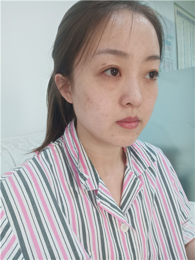 黑龙江瑞丽杨永胜自体脂肪全脸填充怎么样?案例分享