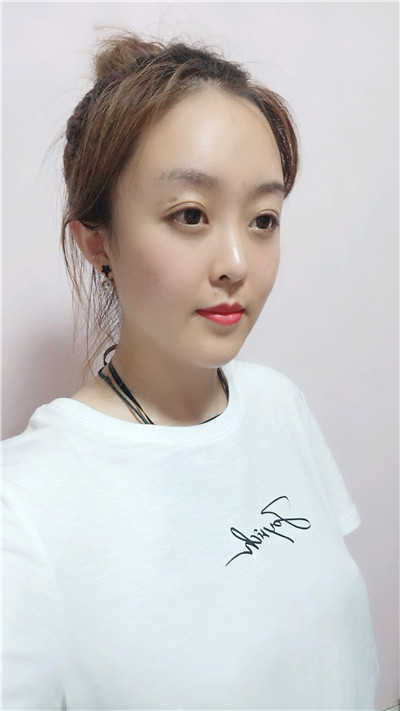 黑龙江瑞丽杨永胜自体脂肪全脸填充怎么样?案例分享