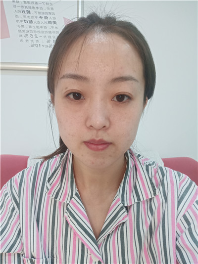 黑龙江瑞丽杨永胜自体脂肪全脸填充怎么样?案例分享
