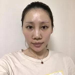 郑州元素美学鲁亚东鼻部手术怎么样?案例分享