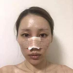 郑州元素美学鲁亚东鼻部手术怎么样?案例分享