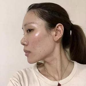 郑州元素美学鲁亚东鼻部手术怎么样?案例分享
