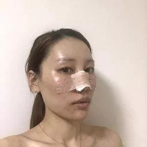 郑州元素美学鲁亚东鼻部手术怎么样?案例分享