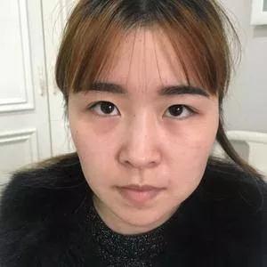 重庆军科乔少然眼鼻部手术怎么样?案例分享