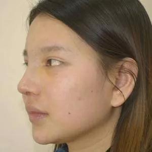 广州艺美李闯鼻部手术怎么样?案例分享