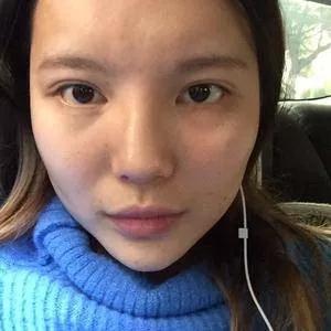 广州艺美李闯鼻部手术怎么样?案例分享
