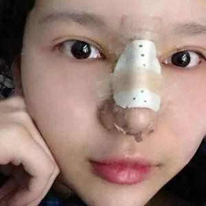 广州艺美李闯鼻部手术怎么样?案例分享
