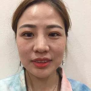 广州华美李文峰鼻部手术+面部填充怎么样?案例分享