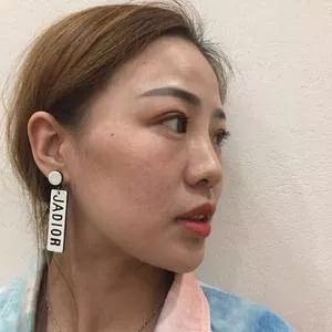 广州华美李文峰鼻部手术+面部填充怎么样?案例分享
