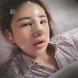 广州华美李文峰鼻部手术+面部填充怎么样?案例分享