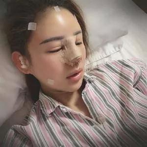 广州华美李文峰鼻部手术+面部填充怎么样?案例分享