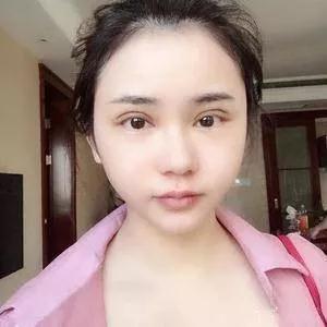 温州艺星黄乐眼部手术怎么样?案例分享