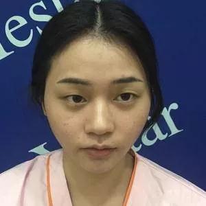 温州艺星黄乐眼部手术怎么样?案例分享