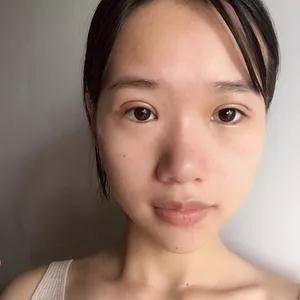 深圳艺星潘华眼部手术怎么样?案例分享