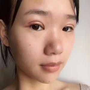 深圳艺星潘华眼部手术怎么样?案例分享