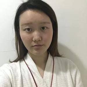 南宁韩成刘彬鼻部手术怎么样?案例分享