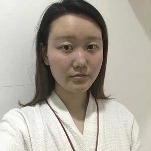 南宁韩成刘彬鼻部手术怎么样?案例分享