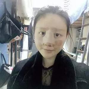 南宁韩成刘彬鼻部手术怎么样?案例分享