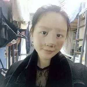 南宁韩成刘彬鼻部手术怎么样?案例分享
