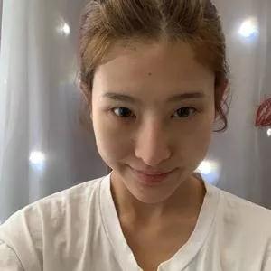 成都美容王立鹏全切双眼皮怎么样?案例分享