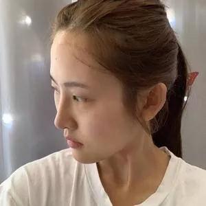 成都美容王立鹏全切双眼皮怎么样?案例分享