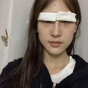 成都美容王立鹏全切双眼皮怎么样?案例分享