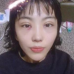 深圳健丽席海忠眼部手术怎么样?案例分享