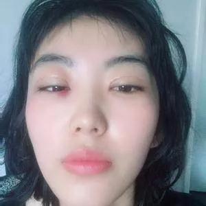 深圳健丽席海忠眼部手术怎么样?案例分享