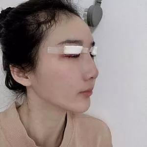 成都中医大银海何军眼部手术怎么样?案例分享