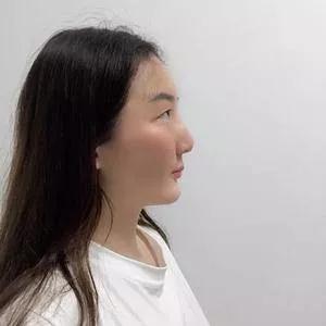 成都中医大银海何军眼部手术怎么样?案例分享