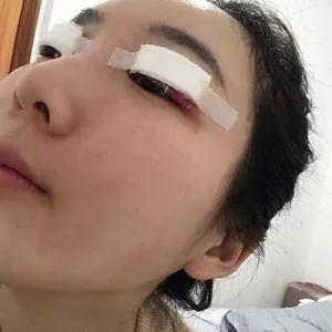 成都中医大银海何军眼部手术怎么样?案例分享