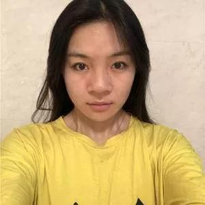 杭州东方鼻部手术怎么样?案例分享