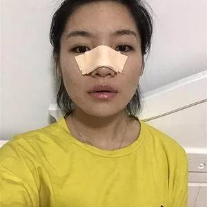 杭州东方鼻部手术怎么样?案例分享