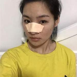 杭州东方鼻部手术怎么样?案例分享