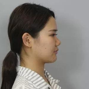 深圳阳光罗志敏鼻部手术怎么样?案例分享