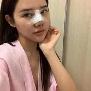 深圳阳光罗志敏鼻部手术怎么样?案例分享