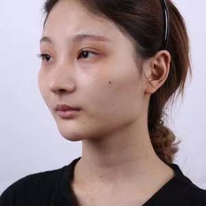 上海华美李志海下颌角+颧骨内推+眼部手术怎么样?案例分享