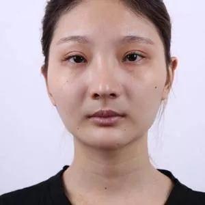 上海华美李志海下颌角+颧骨内推+眼部手术怎么样?案例分享