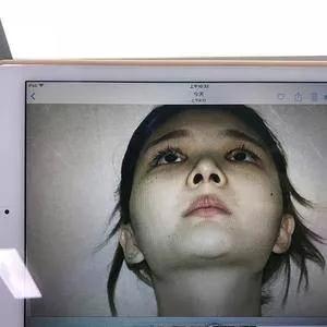 上海华美李志海下颌角+颧骨内推+眼部手术怎么样?案例分享