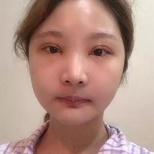上海华美李志海下颌角+颧骨内推+眼部手术怎么样?案例分享