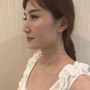 武汉华美马行鼻修复怎么样?案例分享