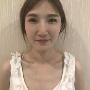 武汉华美马行鼻修复怎么样?案例分享