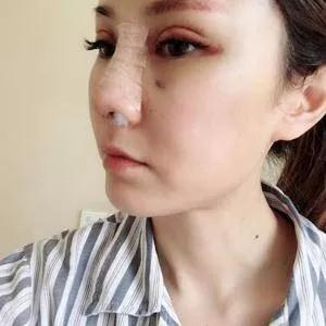 武汉华美马行鼻修复怎么样?案例分享
