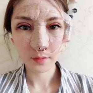 武汉华美马行鼻修复怎么样?案例分享