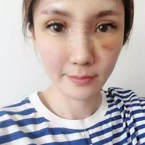 武汉华美马行鼻修复怎么样?案例分享