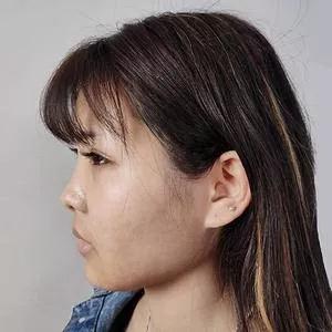 合肥白领安琪儿胡准鼻部手术怎么样?案例分享