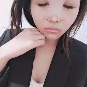 合肥白领安琪儿胡准鼻部手术怎么样?案例分享