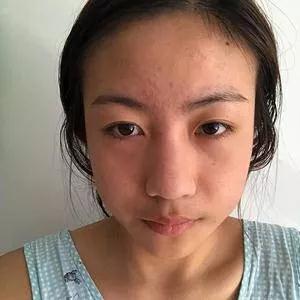 重庆万家燕王珍祥鼻部手术怎么样?案例分享