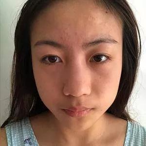 重庆万家燕王珍祥鼻部手术怎么样?案例分享